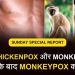Monkeypox Virus Hindi Symptoms, Prevention, Treatment