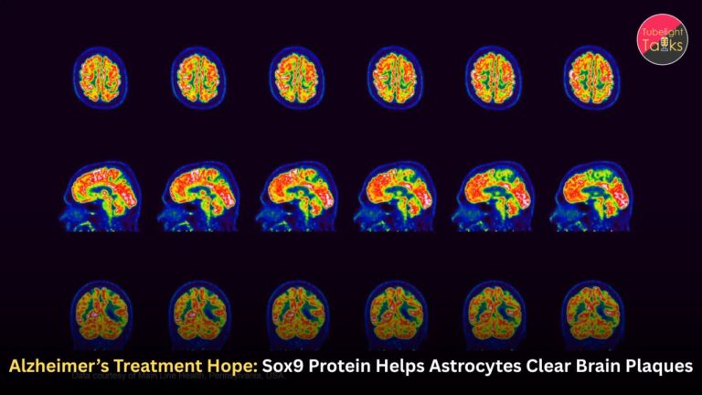 Alzheimer’s Treatment Hope: Sox9 Protein Helps Astrocytes Clear Brain Plaques