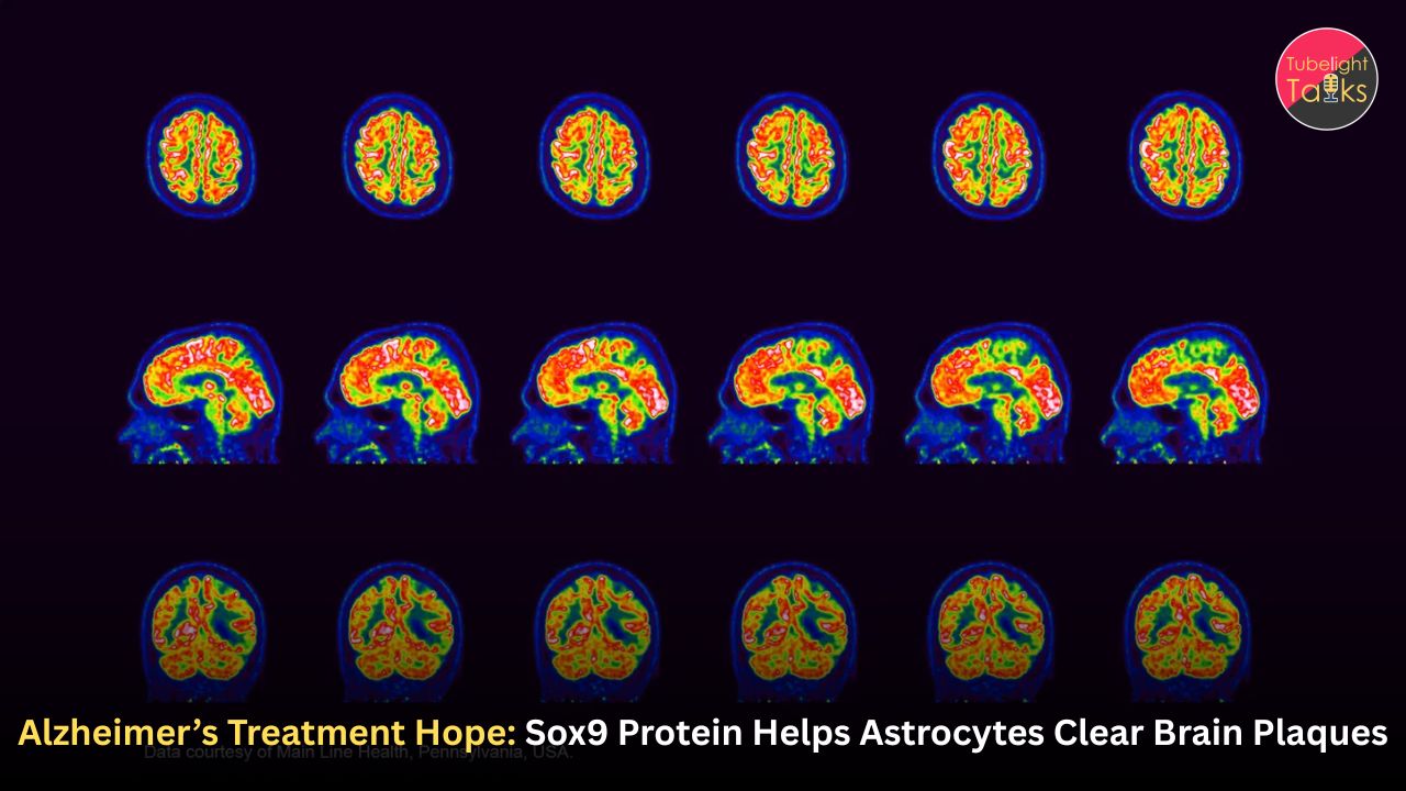 Alzheimer’s Treatment Hope: Sox9 Protein Helps Astrocytes Clear Brain Plaques